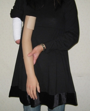 装着例:30代女性(上腕義手)