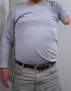 装着例:60代男性(上腕義手)