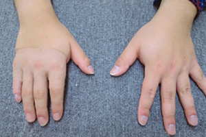 装着例:20代男性(右2,3,4指欠損 半手部式)