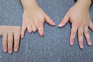 装着例:20代男性(右2,3,4指欠損 半手部式)