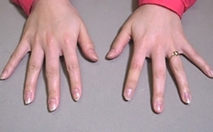 装着例：10代女性（手指義手ショートタイプアクリル爪付き）