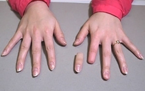 装着例：10代女性（手指義手ショートタイプアクリル爪付き）