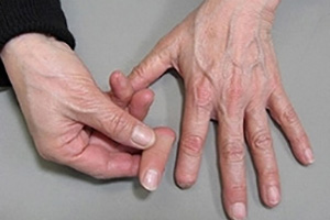 装着例:40代男性(手指義手ショートタイプ)