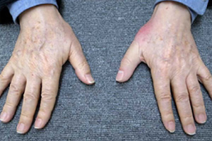 装着例:60代男性(手指義手)