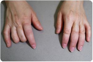装着例:40代女性(右2指手指義手・左2,3,4指手指義手ショートタイプ)