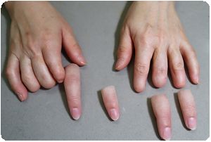 装着例:40代女性(右2指手指義手・左2,3,4指手指義手ショートタイプ)