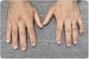装着例:50代男性(3,4指手指義手ショートタイプ)