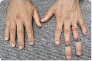 装着例:50代男性(3,4指手指義手ショートタイプ)