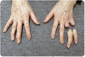 装着例:70代女性